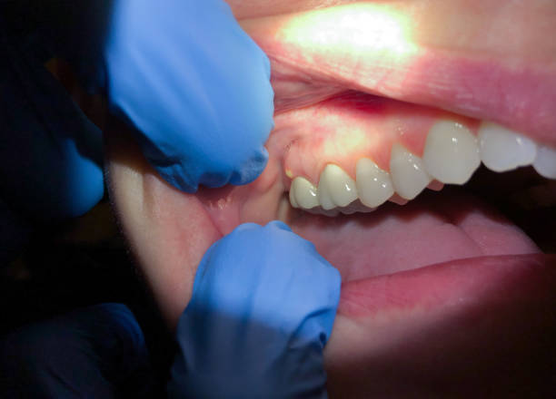 Best Emergency Gum Treatment in Tonto Basin, AZ